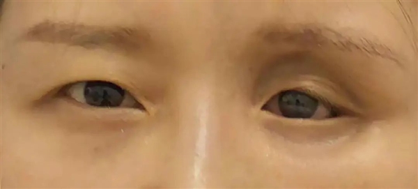 女子眼睛里竟藏了23个隐形眼镜！像煎饼一样叠着 竟无知觉