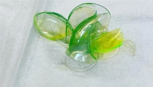 女子眼睛里竟藏了23个隐形眼镜！像煎饼一样叠着 竟无知觉